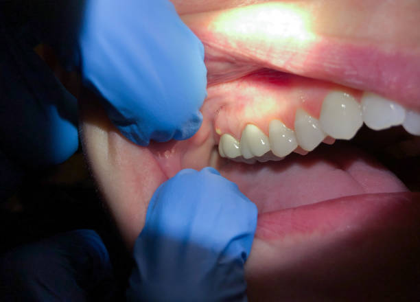 Best Emergency Wisdom Teeth Removal in New Madison, OH